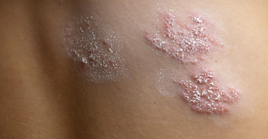 Tilintetgøre dybde velstand Psoriasis Baton Rouge - Dermatology and Aesthetic Institute