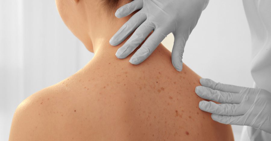Skin Cancer Screening and Treatment: Why is Screening is important