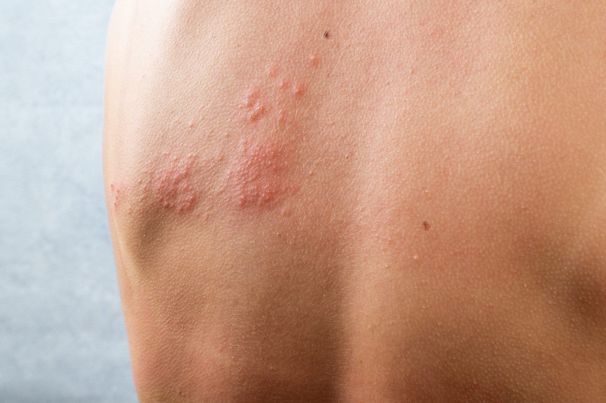 Dermatitis / Eczema