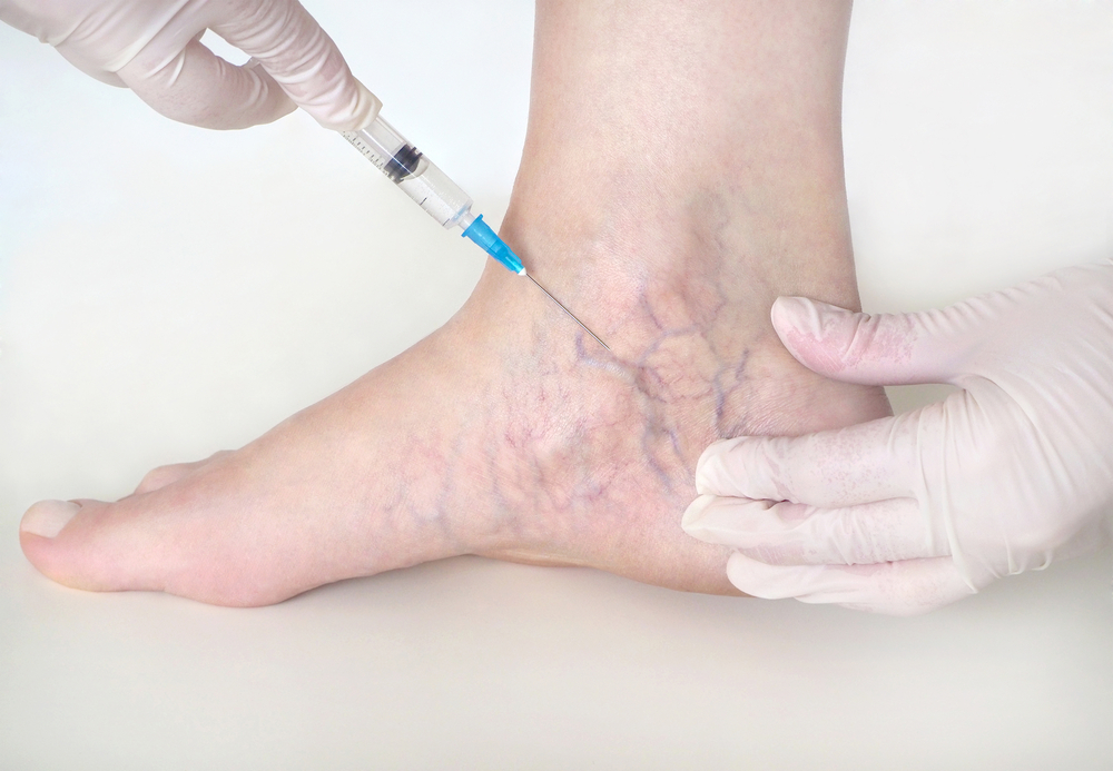 How Does Sclerotherapy Work 638089444261002658