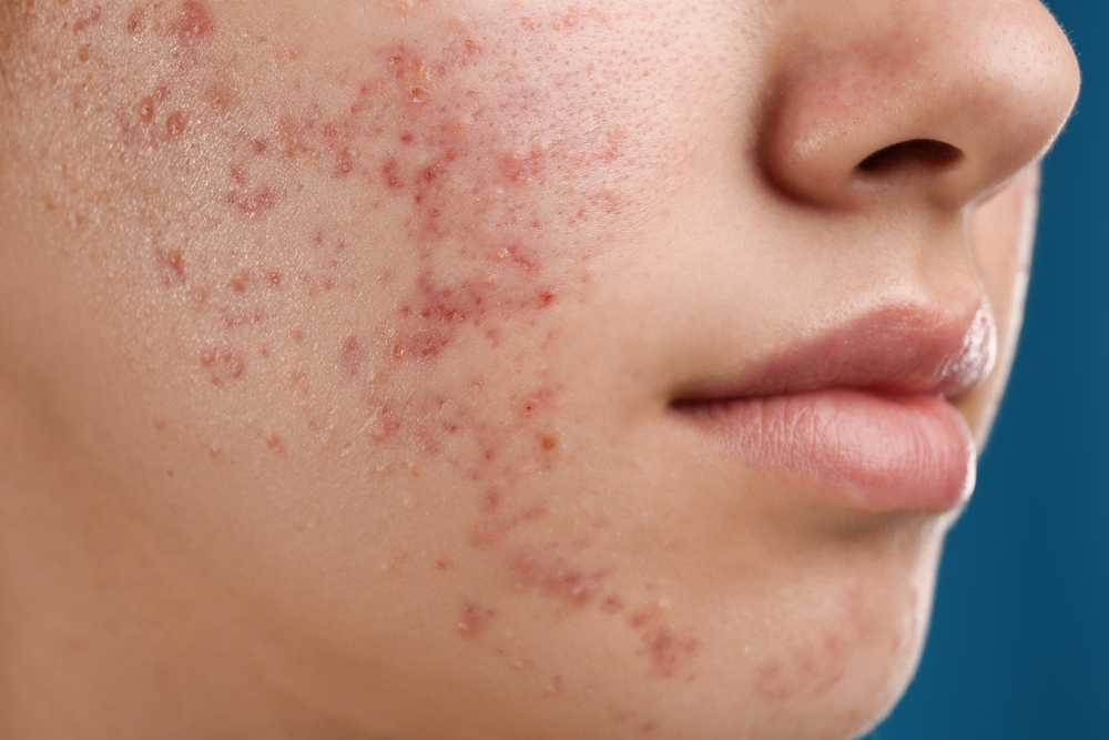 How Long Does Acne Treatment Take 638085076521803080