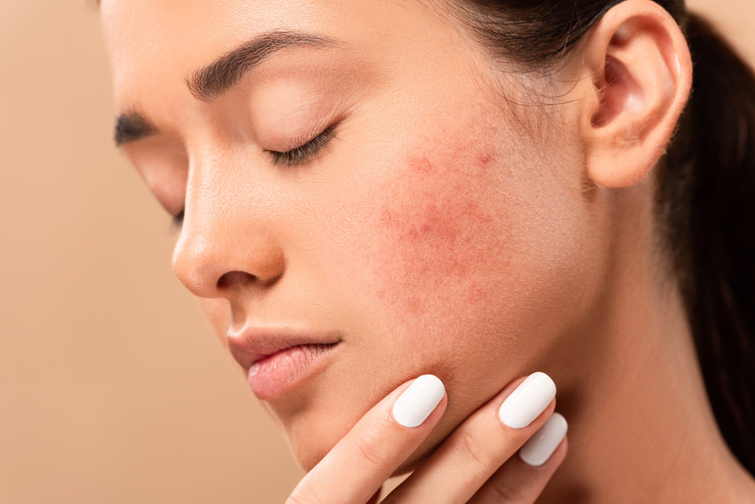 young woman with closed eyes touching face with acne isolated on About Flexile Classic