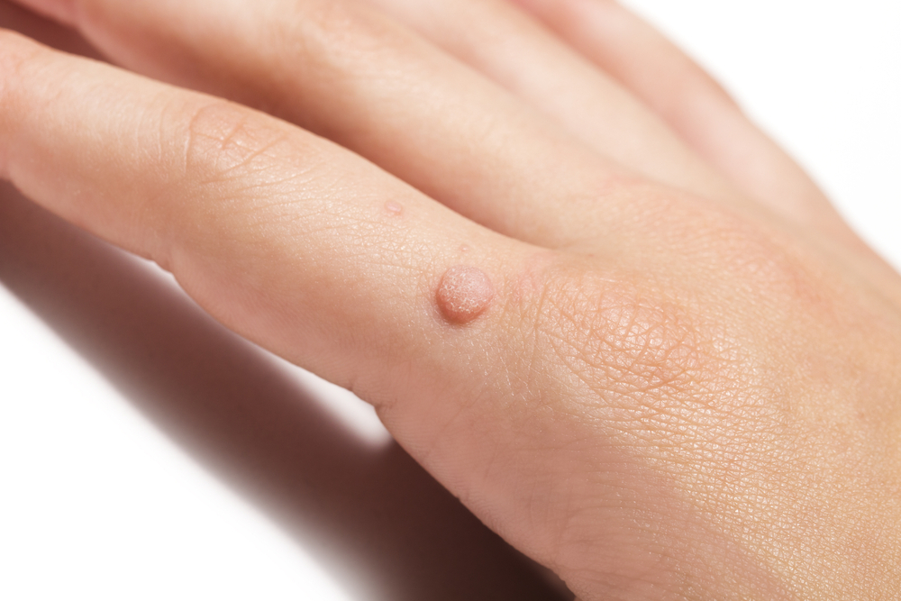 A Closer Look at Hand Warts: Causes & Preventions | Nunnally Dermatology