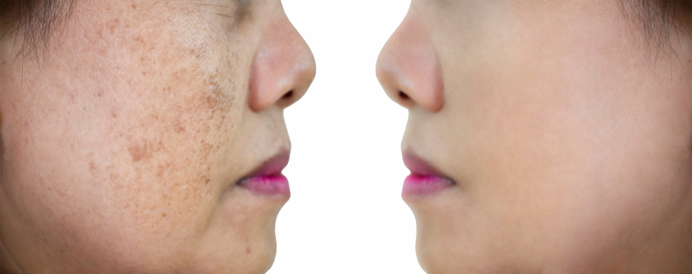 Age Spot Removal | Nunnally Dermatology