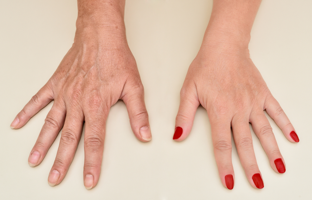 Hand Rejuvenation | Nunnally Dermatology