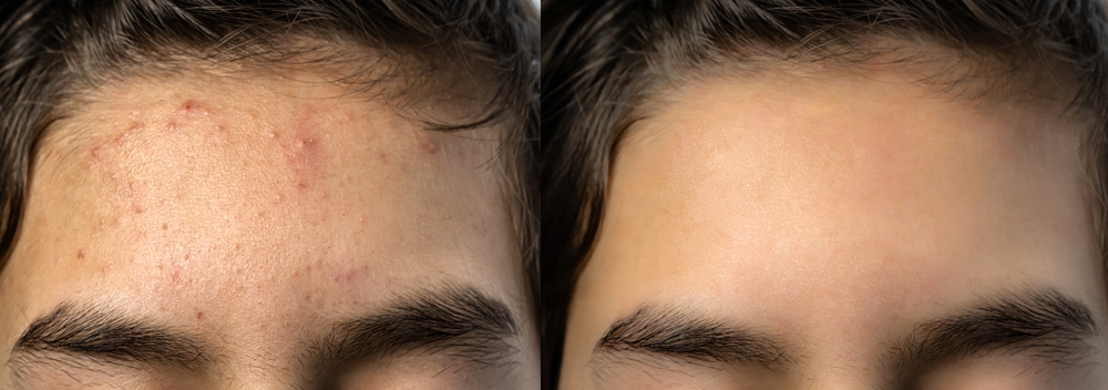 Forehead Acne | Nunnally Dermatology