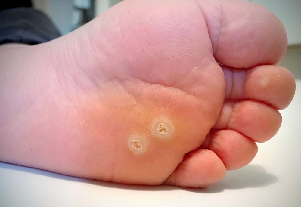 Plantar Warts | Nunnally Dermatology