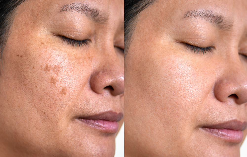 Demystifying Age Spots: What Are They and How to Treat Them