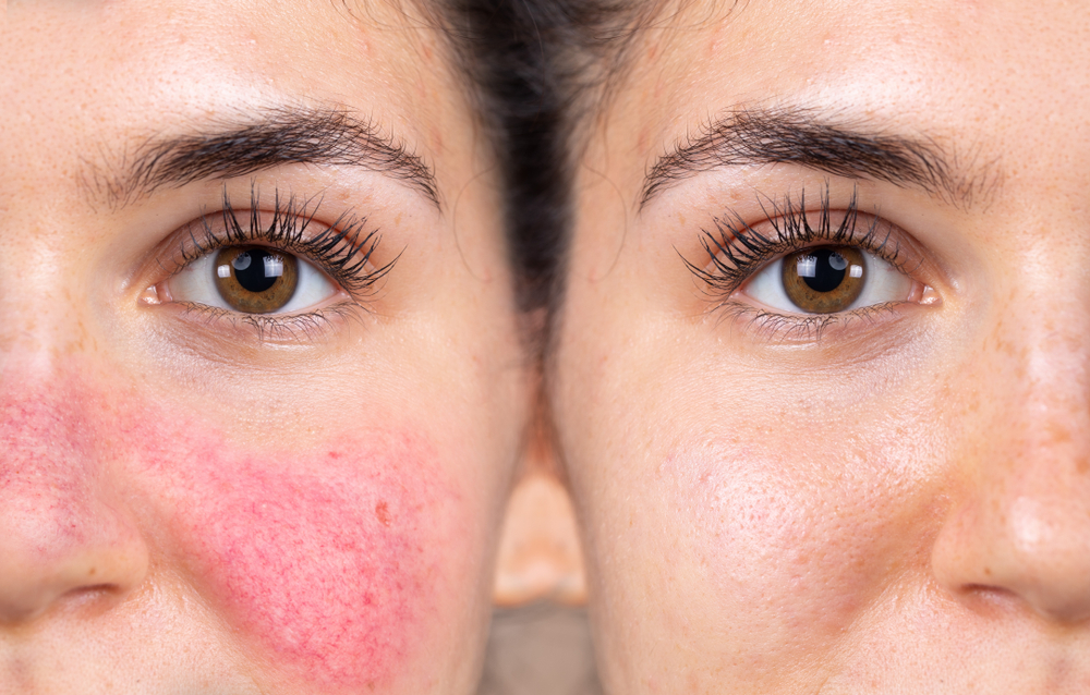 Rosacea Treatment | Nunnally Dermatology