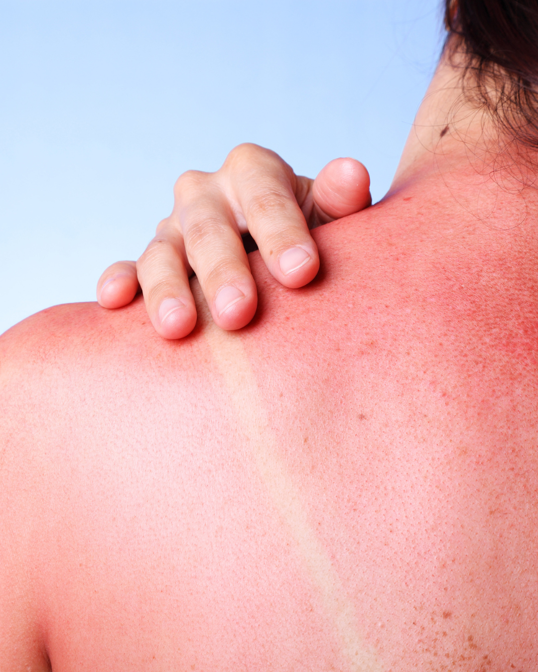 How to Choose the Right Sunscreen for Your Skin Type | Best SPF for Acne-Prone, Sensitive & Dry Skin